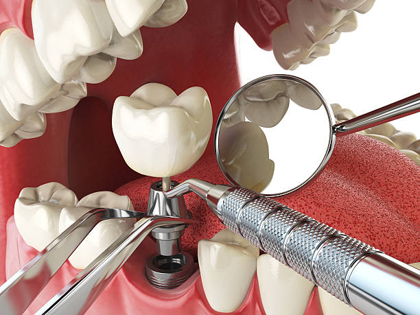 Best Emergency Treatment for Dental Infections or Abscesses in Ladera Heights, CA